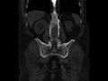 Ankylosing spondylitis (Radiopaedia 44609-48357 Coronal bone window 65).jpg