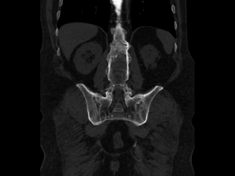 File:Ankylosing spondylitis (Radiopaedia 44609-48357 Coronal bone window 65).jpg