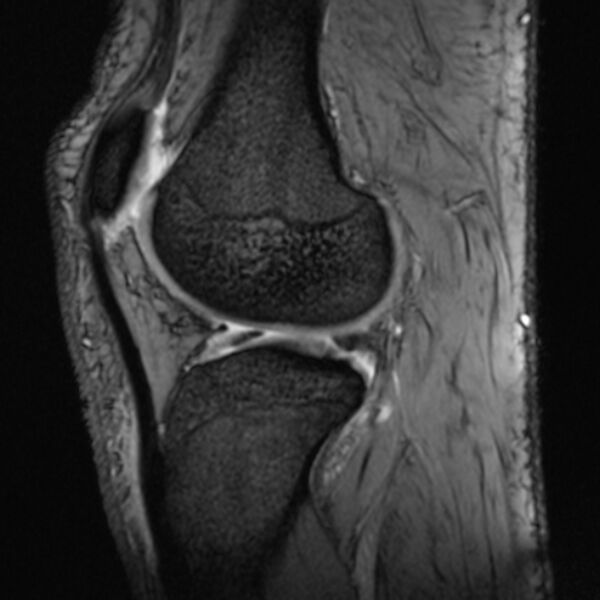 File:Anterior cruciate ligament tear - ramp lesion (Radiopaedia 71883-82322 Sagittal T2 fat sat 9).jpg