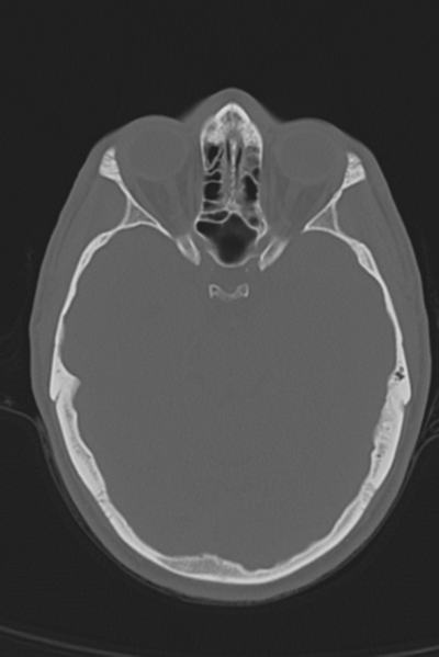 File:Anterior nasal spine fracture (Radiopaedia 46138-50494 Axial bone window 37).png