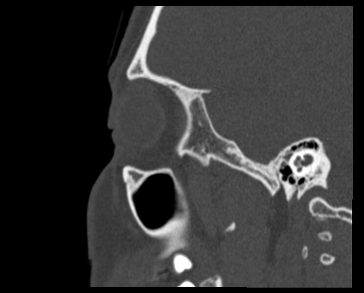 File:Antrochoanal polyp (Radiopaedia 21894-21868 Sagittal bone window 36).jpg