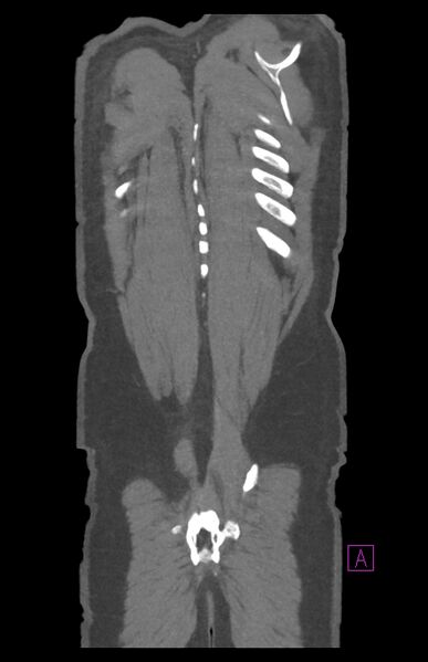File:Aortectomy and axillary-bifemoral bypass (Radiopaedia 28303-28545 C 86).jpg