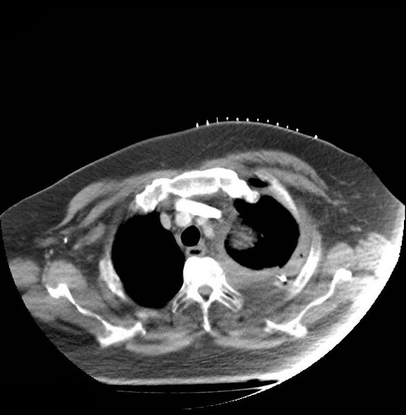 File:Aortic arch false aneurysm (Radiopaedia 14667-14588 A 2).jpg