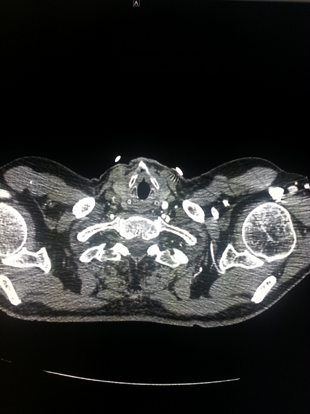 File:Aortic dissection (Radiopaedia 24884).png