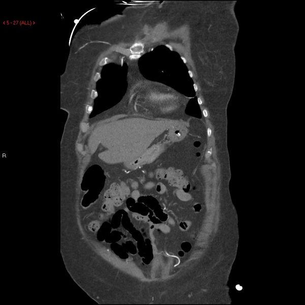 File:Aortic intramural hematoma (Radiopaedia 27746-28001 B 4).jpg
