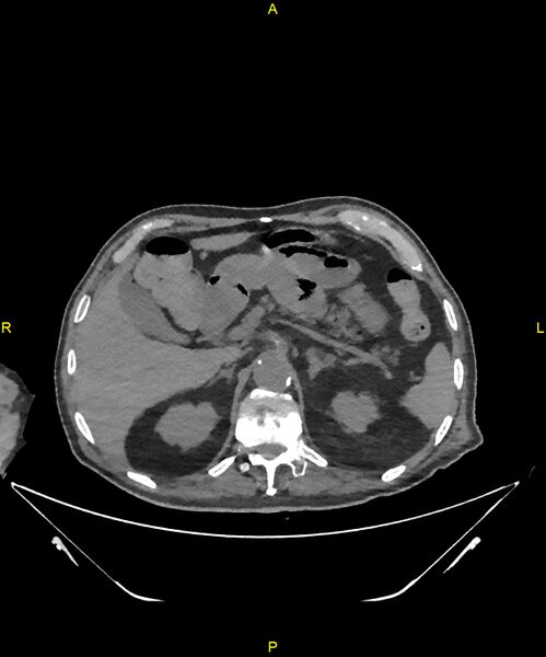 File:Aortoenteric fistula (Radiopaedia 84308-99603 Axial non-contrast 80).jpg