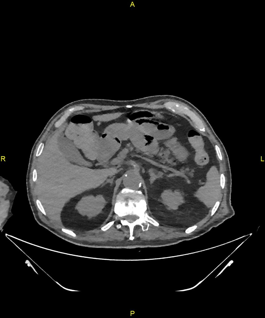 Aortoenteric fistula (Radiopaedia 84308-99603 Axial non-contrast 80).jpg