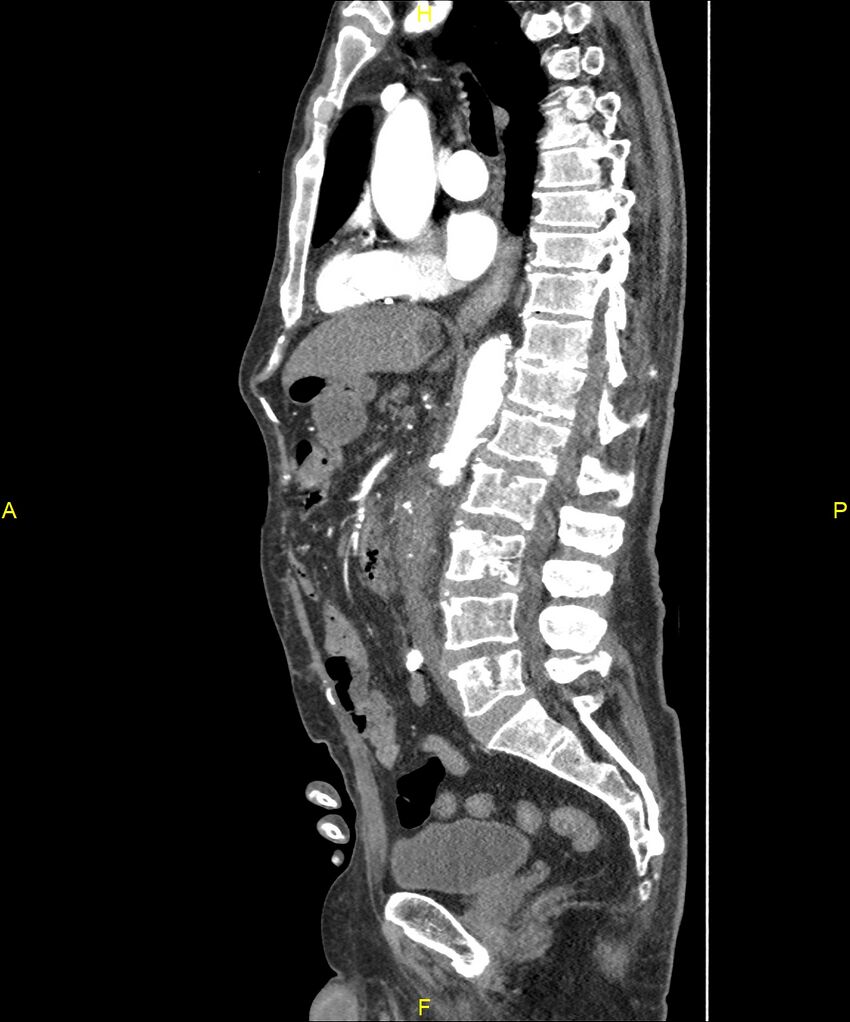 Aortoenteric fistula (Radiopaedia 84308-99603 C 173).jpg