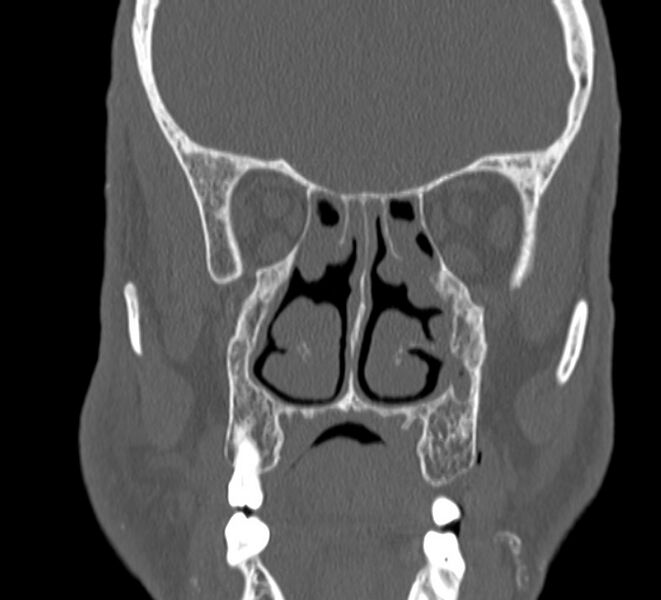 File:Aplastic maxillary sinuses (Radiopaedia 60030-67561 Coronal non-contrast 21).jpg