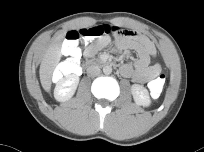 Appendicitis and incidental foregut duplication cyst (Radiopaedia 52962-58916 A 25).jpg