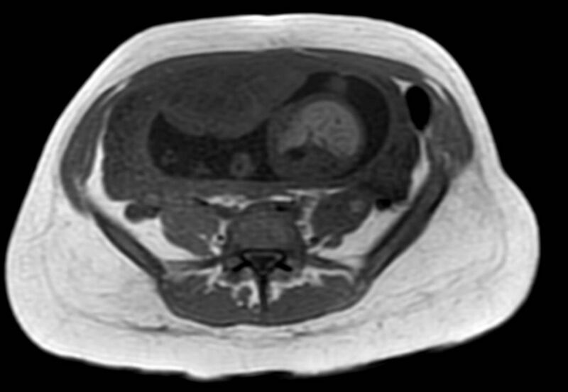 File:Appendicitis in gravida (MRI) (Radiopaedia 89433-106395 Axial T1 in-phase 45).jpg