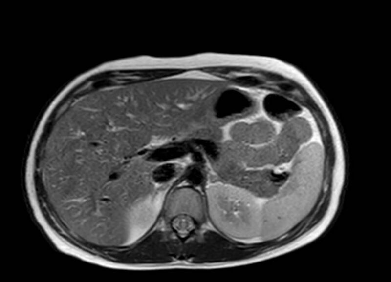 File:Appendicitis in gravida (MRI) (Radiopaedia 89433-106395 Axial T2 15).jpg