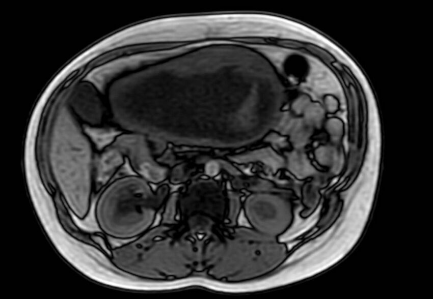 Appendicitis in gravida (MRI) (Radiopaedia 89433-106395 D 27).jpg