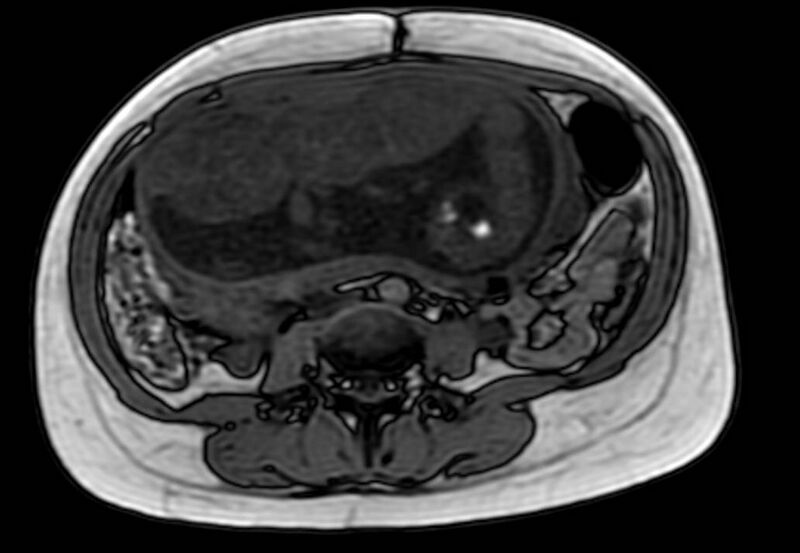 File:Appendicitis in gravida (MRI) (Radiopaedia 89433-106395 D 36).jpg