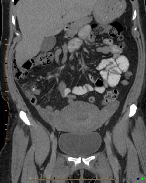 File:Appendicitis post recent cesarian section (Radiopaedia 29594-30102 D 3).jpg