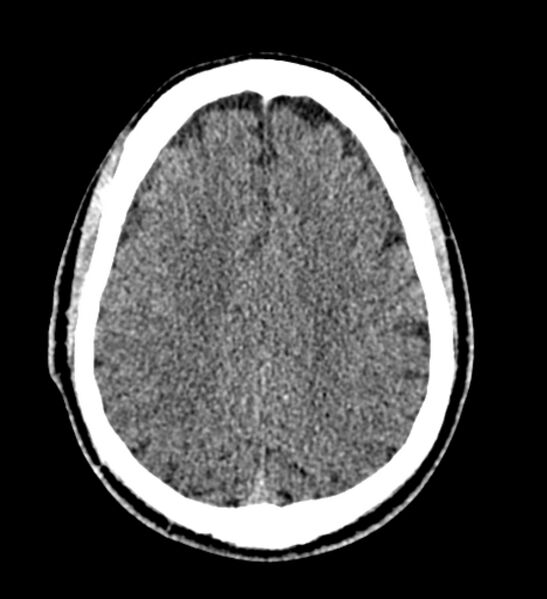File:Arachnoid cyst of the ambient cistern (Radiopaedia 81301-94986 Axial non-contrast 49).jpg