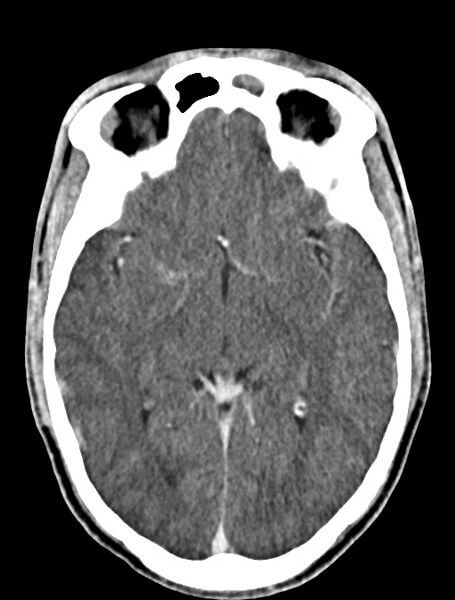 File:Arrow injury to the face (Radiopaedia 73267-84011 Axial C+ delayed 51).jpg