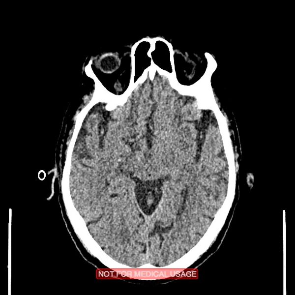 File:Artery of Percheron infarction (Radiopaedia 28679-28967 Axial non-contrast 52).jpg