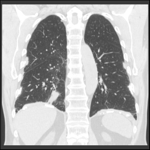 File:Asbestos-related pleural plaques (Radiopaedia 39069-41255 Coronal lung window 26).jpg