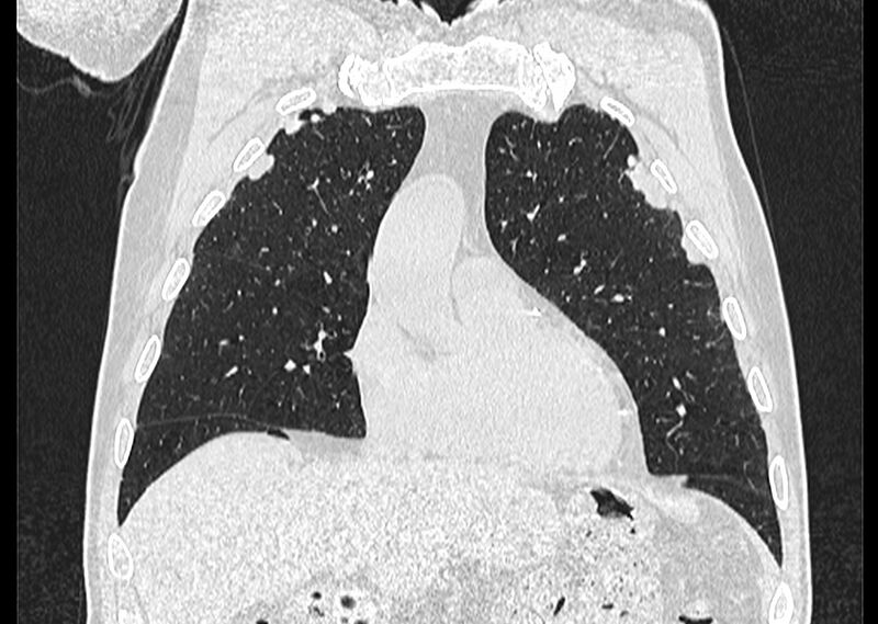 File:Asbestos pleural placques (Radiopaedia 57905-64872 Coronal lung window 79).jpg