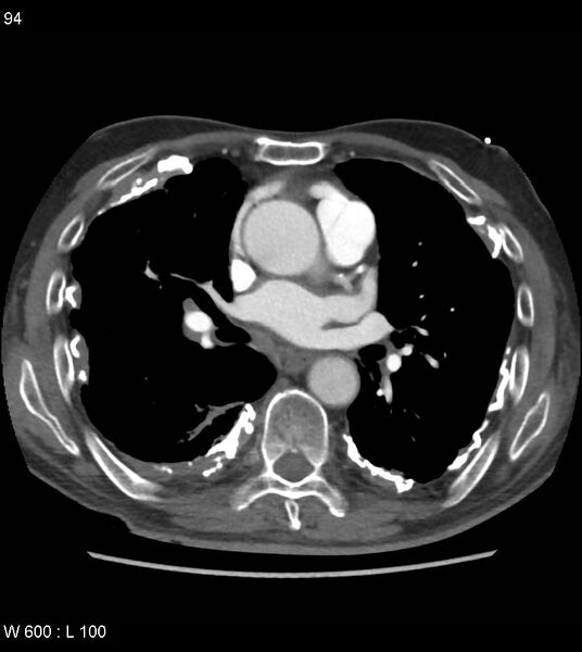 File:Asbestos related lung and pleural disease (Radiopaedia 14377-14301 D 30).jpg