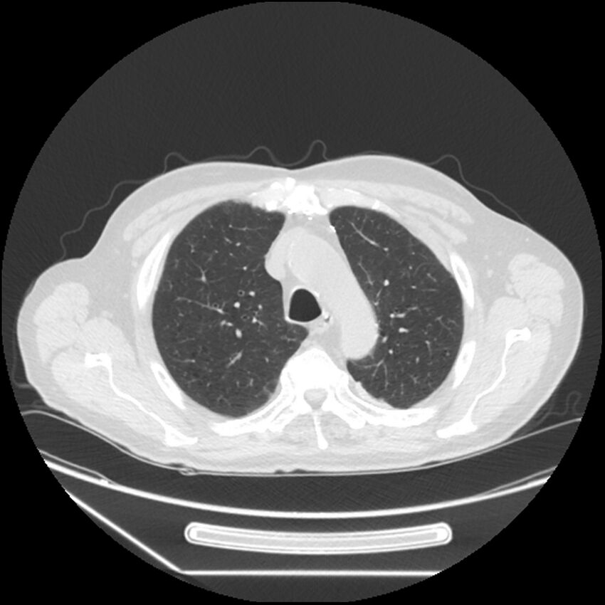 Asbestosis complicated by lung cancer (Radiopaedia 45834-50116 Axial lung window 18).jpg