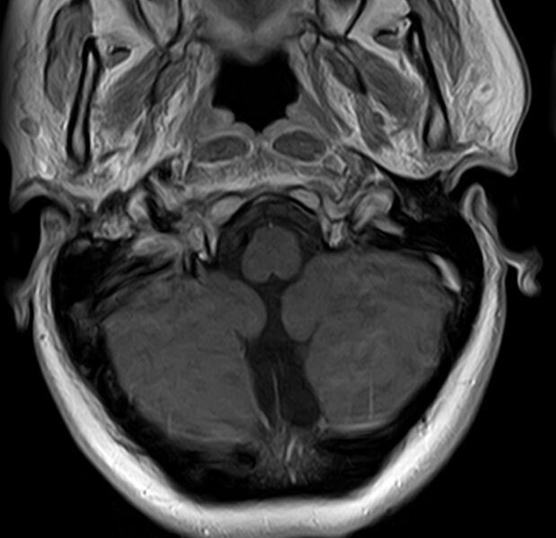 File:Astrocytoma - spinal cord (Radiopaedia 69769-79758 Axial T1 C+ 1).jpg