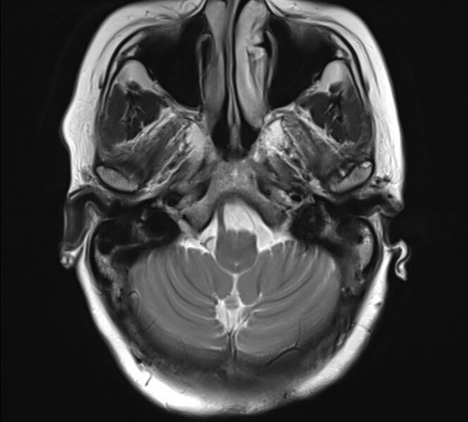File:Atlanto-occipital assimilation with basilar invagination (Radiopaedia 70122-80157 Axial T2 4).jpg