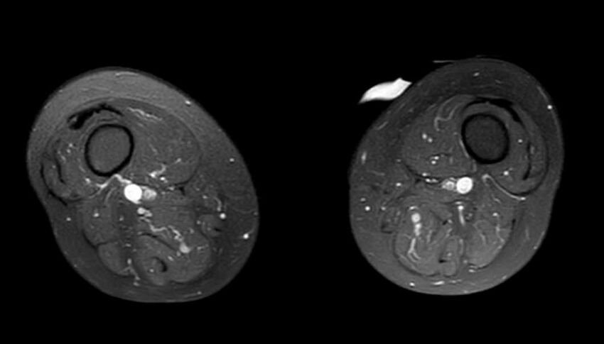 Atypical lipomatous tumor - thigh (Radiopaedia 68975-78734 Axial PD fat sat 31).jpg