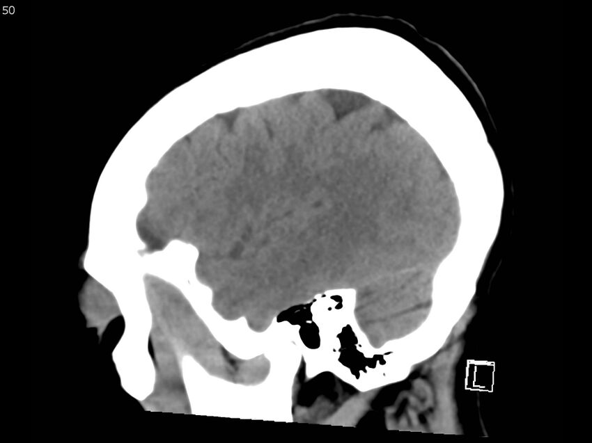 Atypical meningioma - intraosseous (Radiopaedia 64915-73867 C 48).jpg