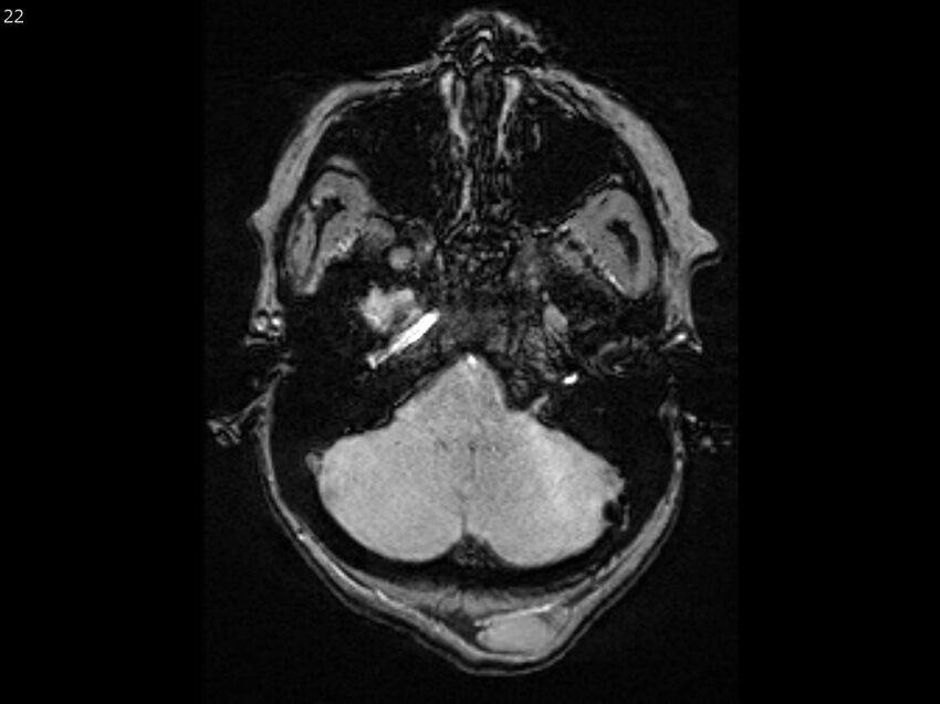 Atypical meningioma - intraosseous (Radiopaedia 64915-74572 Axial SWI 22).jpg