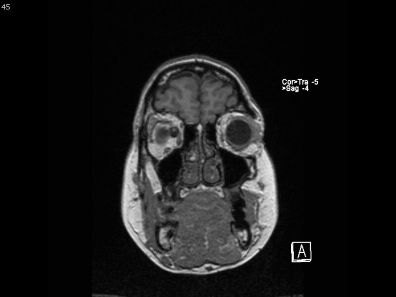 File:Atypical meningioma - intraosseous (Radiopaedia 64915-74572 Coronal T1 45).jpg
