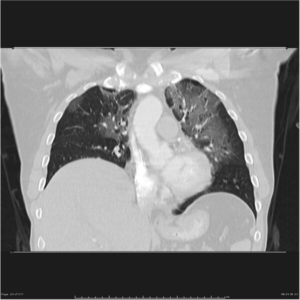 File:Atypical pneumonia - Q fever (Radiopaedia 21993-21989 C 16).jpg