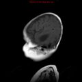 Atypical teratoid rhabdoid tumor (Radiopaedia 10712-11183 Sagittal T1 3).jpg