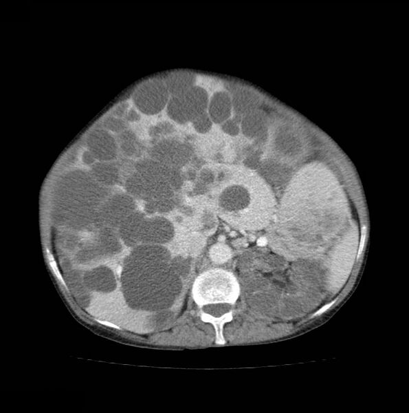 File:Autosomal dominant polycystic kidney disease (Radiopaedia 16777-16490 A 21).jpg