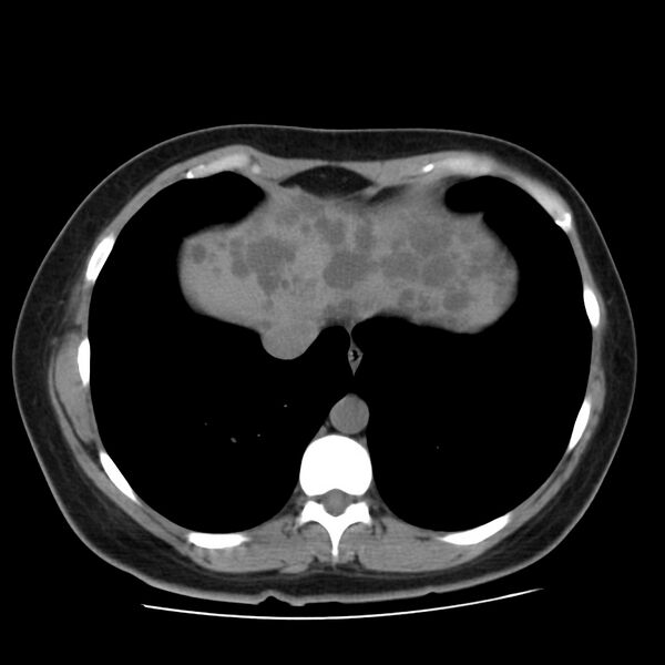 File:Autosomal dominant polycystic kidney disease (Radiopaedia 23061-23093 Axial non-contrast 4).jpg