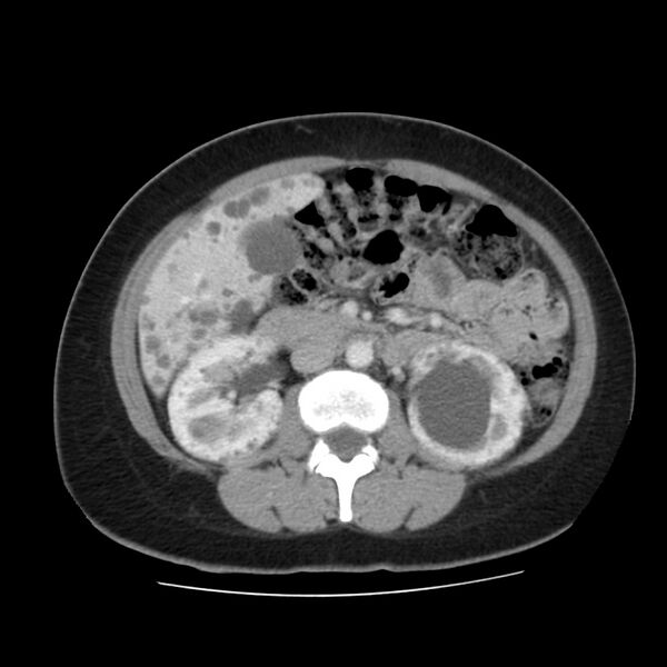 File:Autosomal dominant polycystic kidney disease (Radiopaedia 23061-23093 C 30).jpg