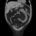 Autosomal dominant polycystic kidney disease (Radiopaedia 36539-38101 C 19).jpg