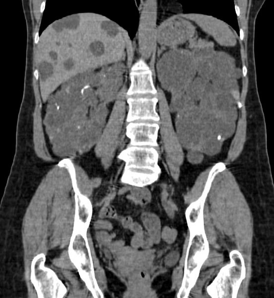 File:Autosomal dominant polycystic kidney disease (Radiopaedia 41918-44922 Coronal non-contrast 29).jpg