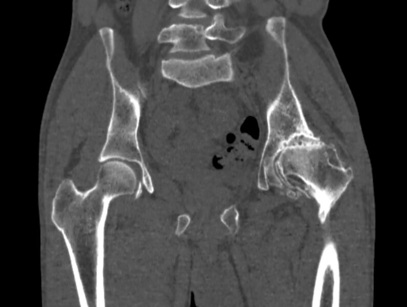 File:Avascular necrosis of the left hip (Radiopaedia 75068-86125 Coronal bone window 37).jpg