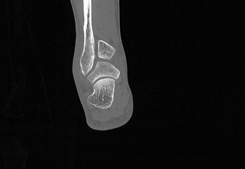 Avulsion fractures of talus and calcaneus (Radiopaedia 48277-53155 Coronal bone window 78).jpg