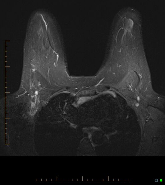 File:Axillary lymphadenopathy on breast MRI- yellow fever vaccination induced (Radiopaedia 19454-19483 Axial T2 fat sat 8).jpg