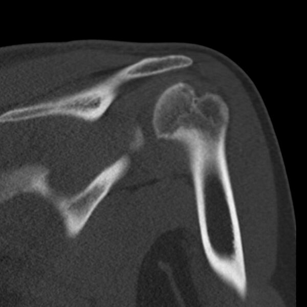 File:Bankart lesion (Radiopaedia 22771-22798 Coronal bone window 29).jpg