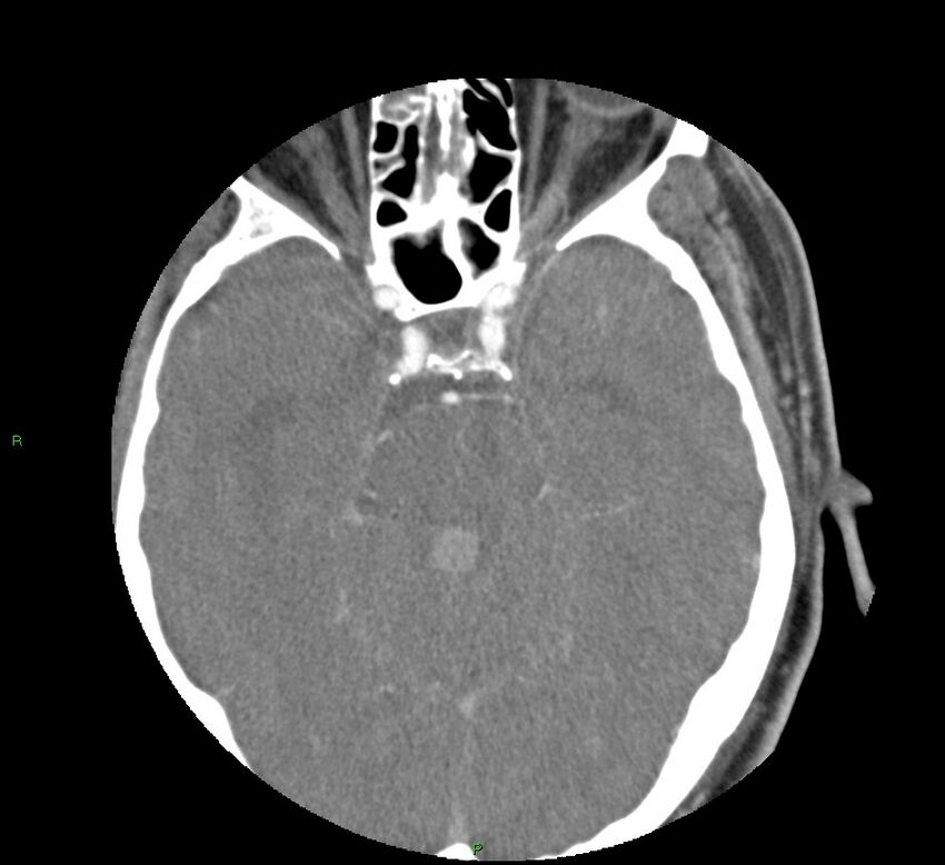 Basal ganglia hemorrhage (Radiopaedia 58763-65985 D 69).jpg