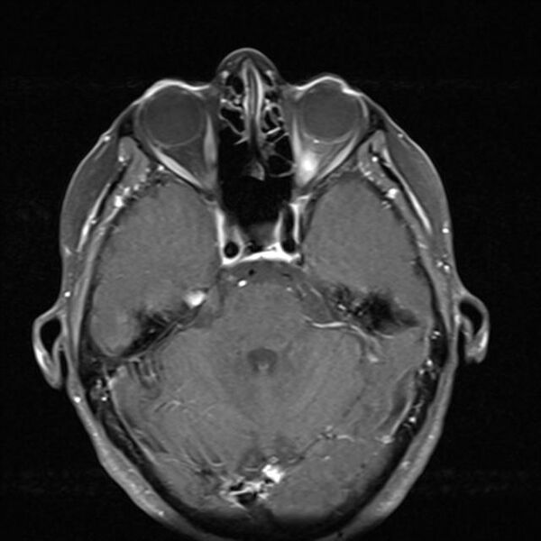 File:Base of skull chondrosarcoma (Radiopaedia 30410-31070 Axial T1 C+ fat sat 13).jpg