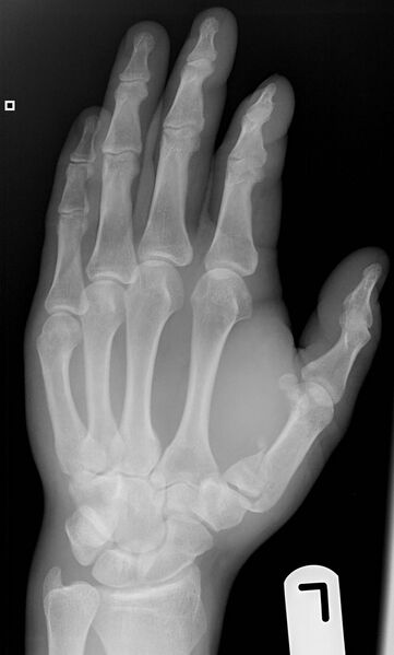 File:Bennett's fracture (Radiopaedia 8803-9605 Oblique 1).jpg