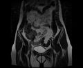 Bicornuate bicollis uterus (Radiopaedia 61626-69616 Coronal T2 8).jpg