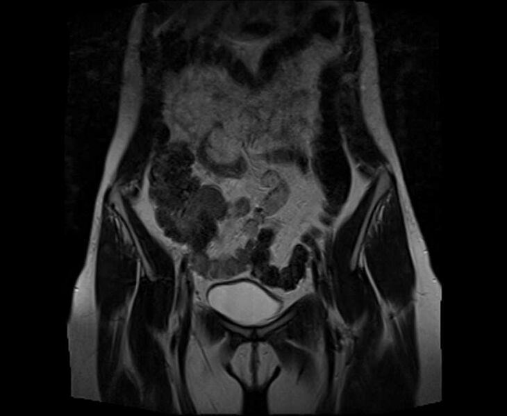 File:Bicornuate bicollis uterus (Radiopaedia 61626-69616 Coronal T2 8).jpg