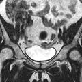 Bicornuate uterus (Radiopaedia 11104-11492 Coronal T2 2).jpg