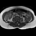 Bicornuate uterus (Radiopaedia 61974-70046 Axial T1 6).jpg